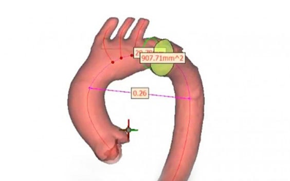 How to Analyze the Centerline of the Aorta 