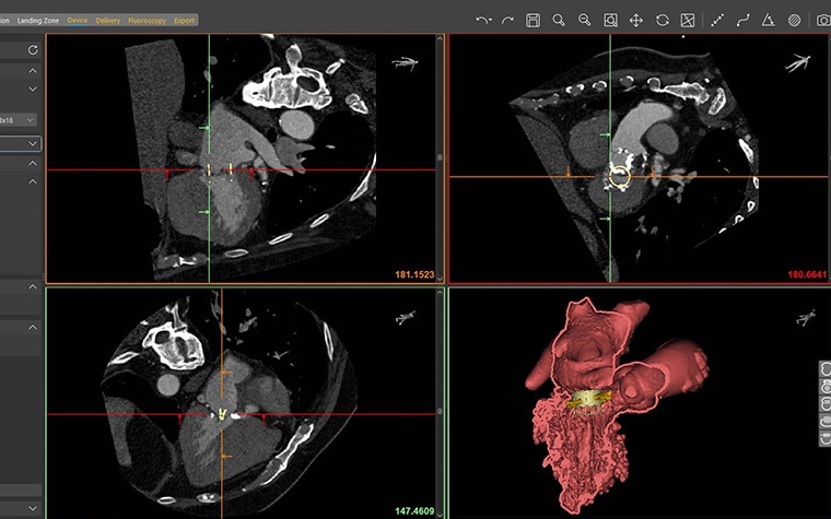 Screenshot of the Mimics Enlight TMVR Planner calculating the neo-LVOT 