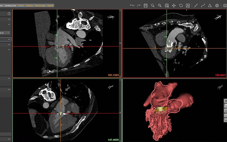 Screenshot des Mimics Enlight TMVR-Planers zur Berechnung des Neo-LVOT