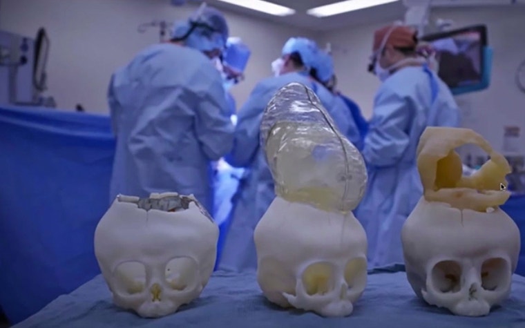 Anatomical models of baby’s skull and brain in the operating room in front of surgeons 
