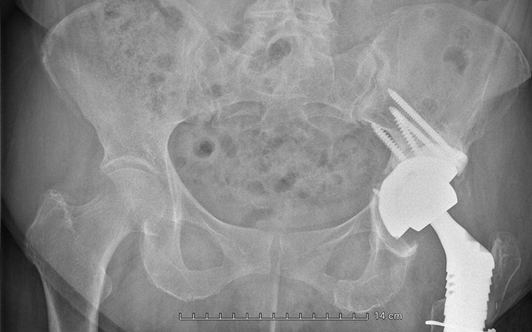 Pre-operative X-ray image of the patient with the failed hip implant