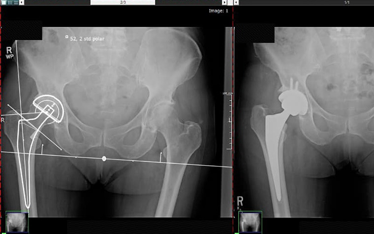 X-ray images of pelvis and hip joint 