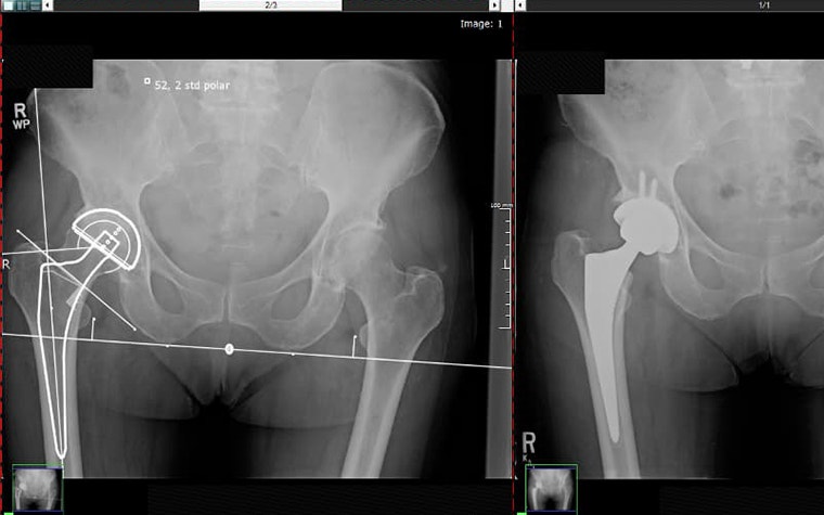 X-ray images of pelvis and hip joint