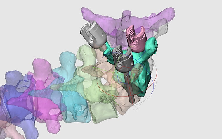 Digital, segmented model of a patient's spine with implants