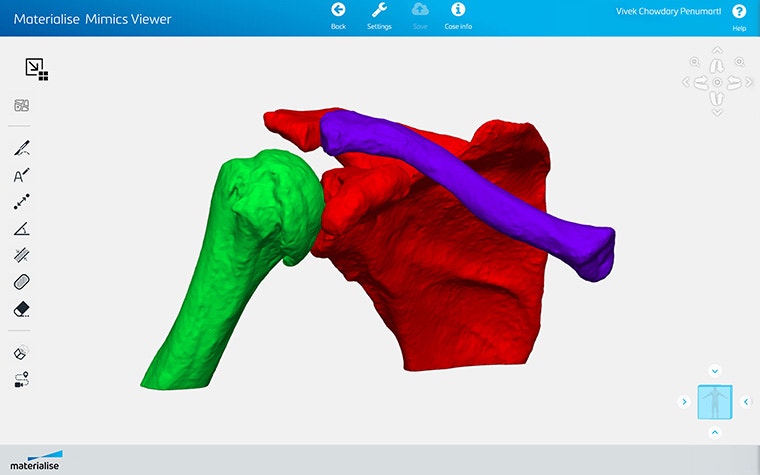 Screenshot of Materialise Mimics Viewer showing segmented shoulder anatomy