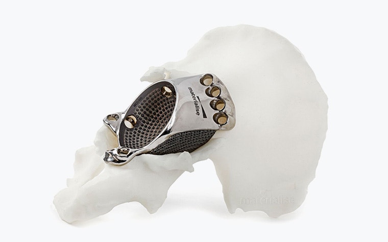 A metal hip implant attached to a bone.