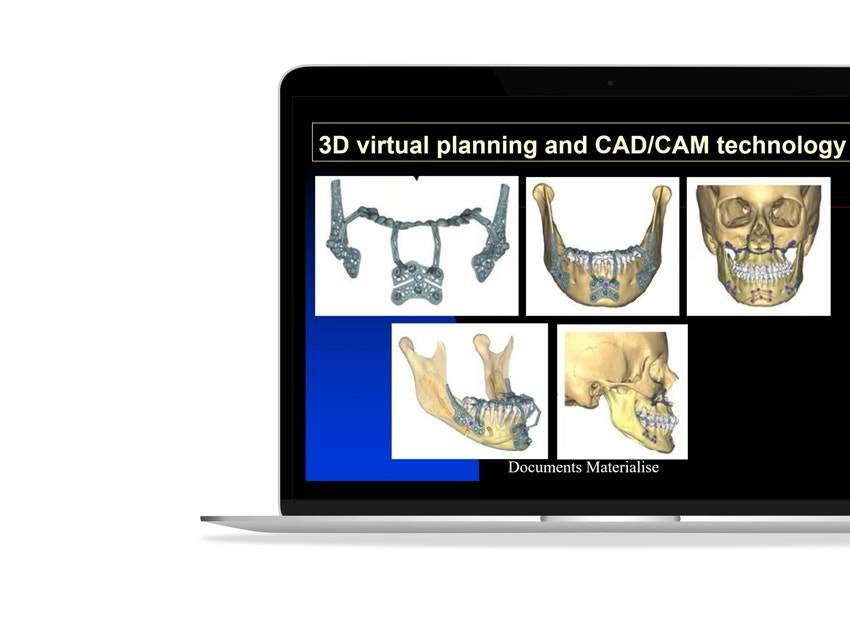 ssd-3d-planning-cad-cam-technology-skulls-s-plate.jpg