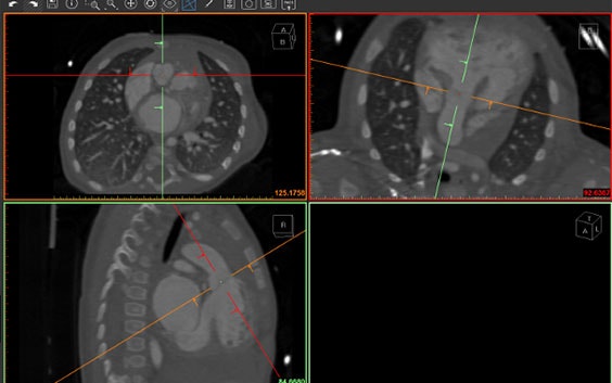 Three X-ray visuals of a chest in software