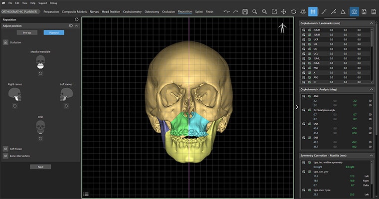 Screenshot of the orthognathic planner in Mimics Enlight CMF with sections of a skull segmented