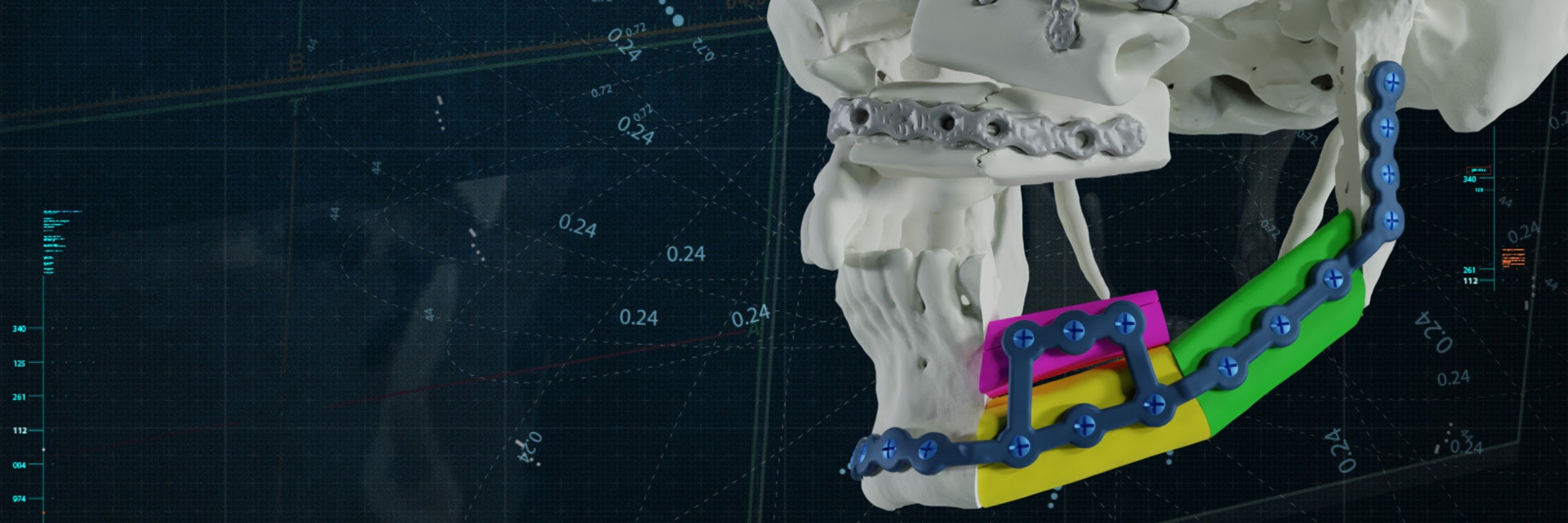 A 3D model of a skull with colorful 3D-printed implants attached to the jaw and implants around the orbital floor