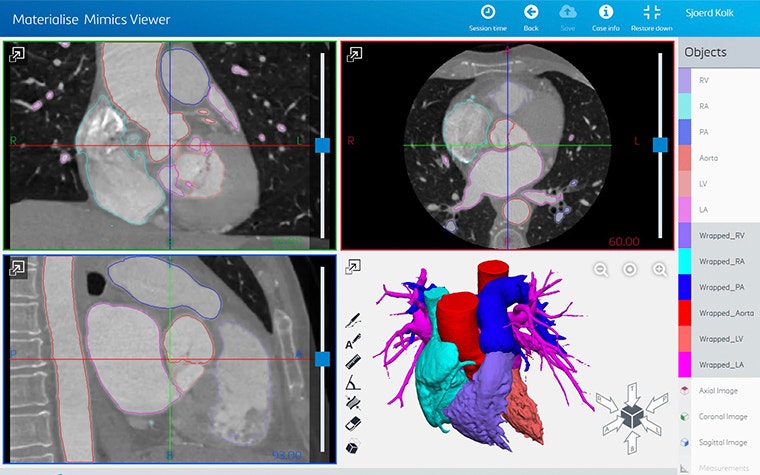 Screenshot of anatomy in Mimics Viewer 