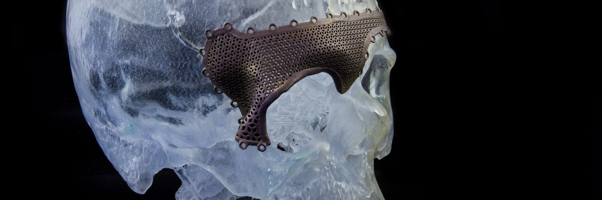 A 3D-printed human skull with cranial plate 