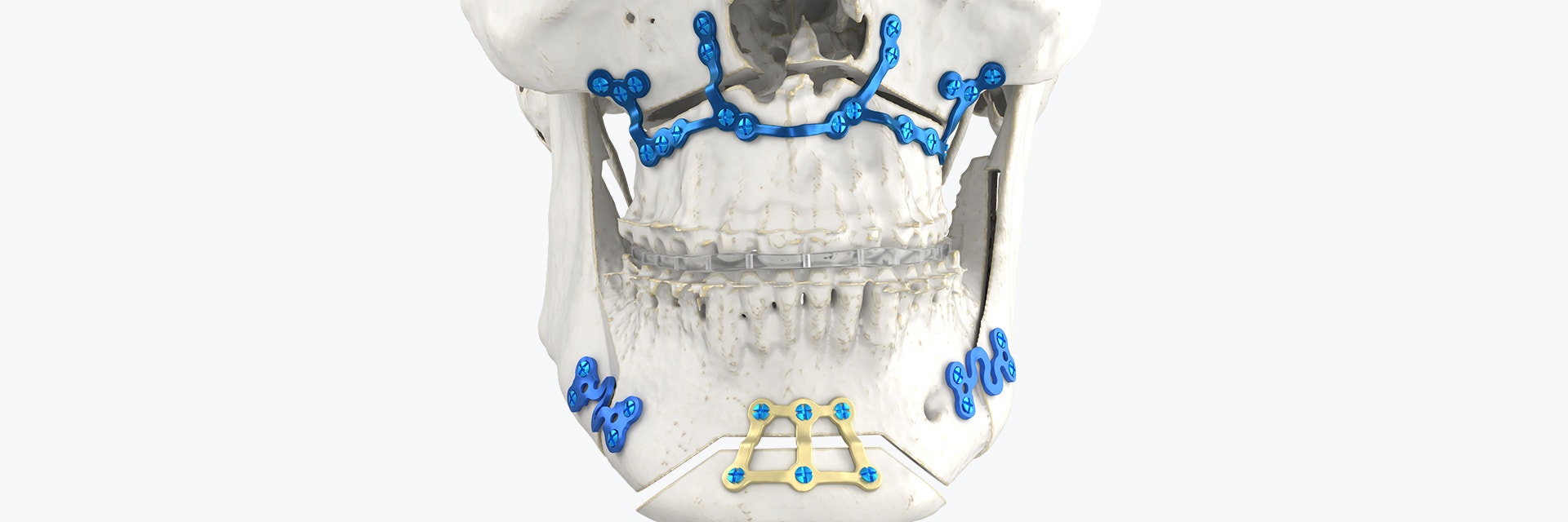 양악 스플린트와 표준 플레이트의 조합을 보여주는 두개골의 턱