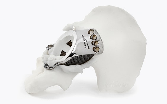Implant imprimé en 3D sur un modèle de hanche
