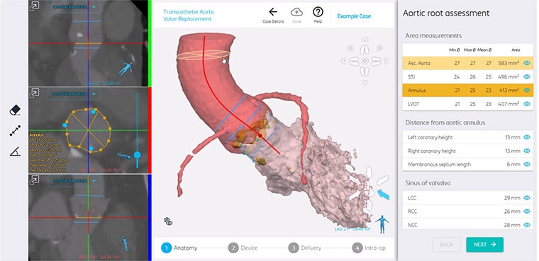 Anatomical overview for a TAVR procedure in Materialise Mimics Planner