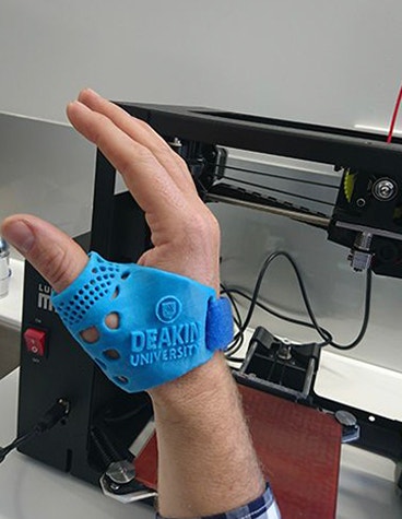Personalized, 3D-printed thumb splint