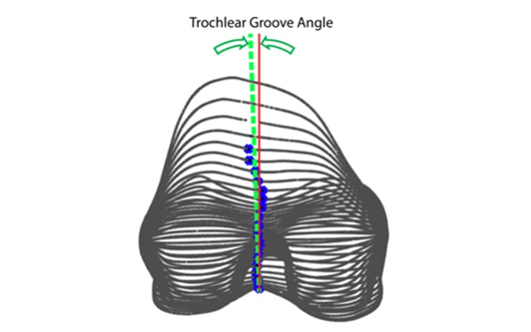 Graphic showing trochlear groove angles