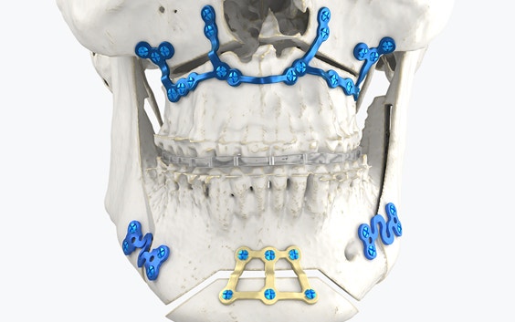 Jaw of a skull showing a combination of an orthognathic splint and standard plates