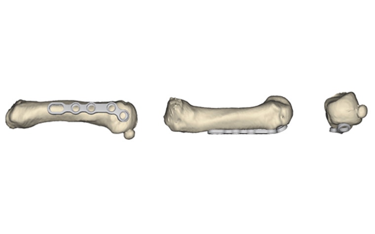 Redesigned metacarpal plate  