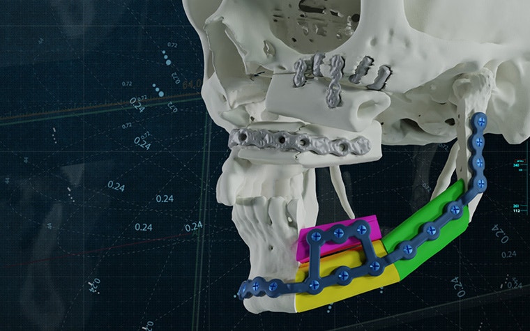 A 3D model of a skull with colorful 3D-printed implants attached to the jaw and implants around the orbital floor