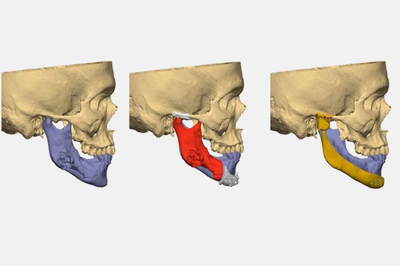 3 profile views of a skull model displaying various jaw implants.
