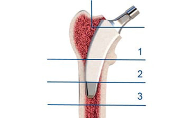 A virtual image of a bone subdivided into the medial, lateral, anterior, and posterior areas