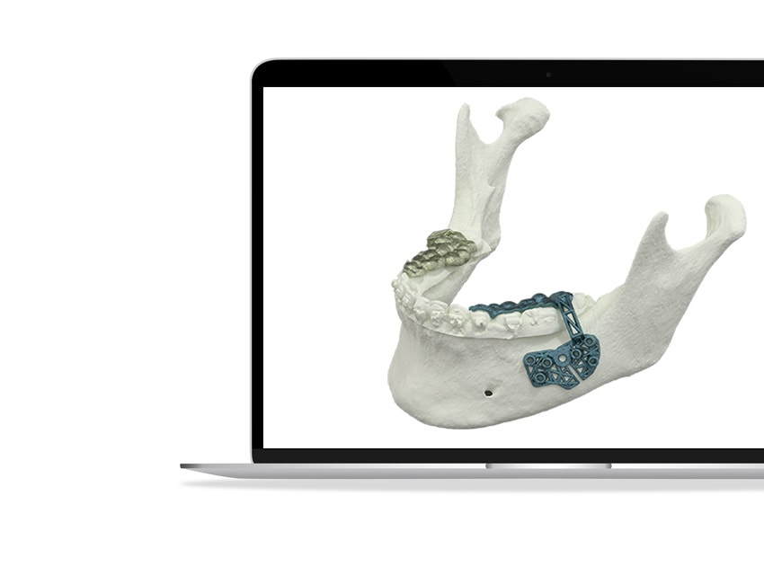 Laptop screen with a model of a lower jaw with personalized metal implants attached