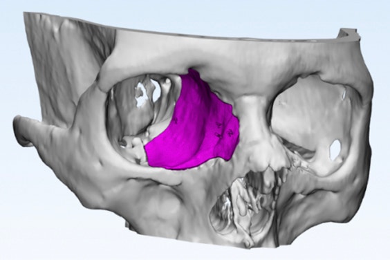 3D model of the skull that mirrors the healthy side