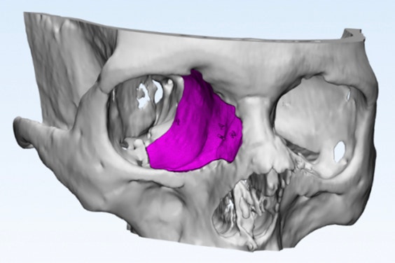 3D model of the skull that mirrors the healthy side 