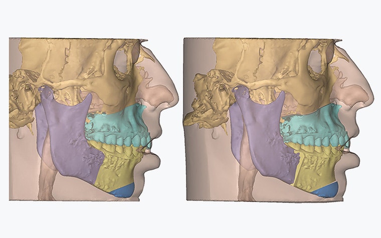 Digital, profile view of a patient's skull with the jaw segmented, showing the difference before and after surgery