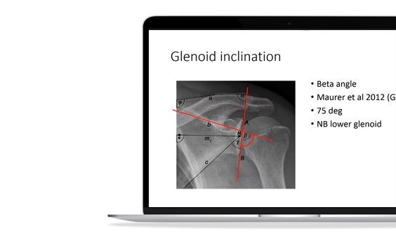 ssm-glenoid-inclination.jpg