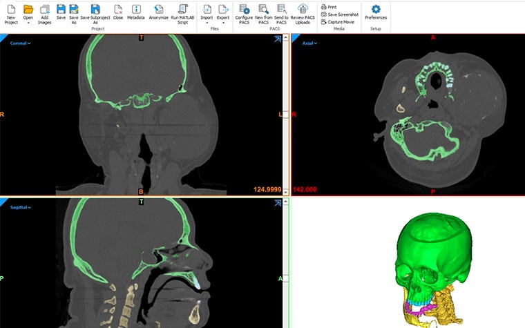 Scans and 3D models of a skull in Mimics Innovation Suite software