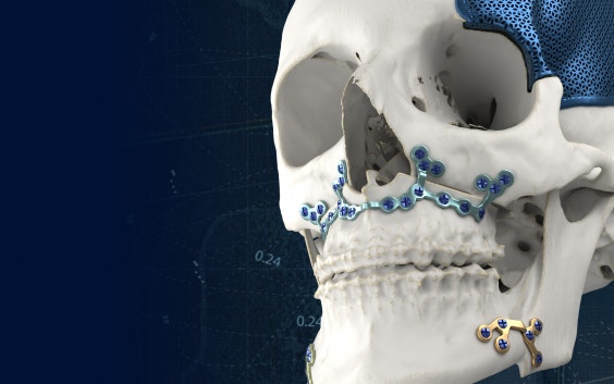Schädelmodell mit 3D-gedruckten befestigten Implantaten