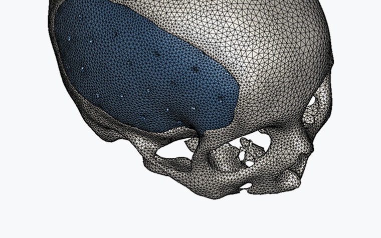 STL image of a skull with an implant