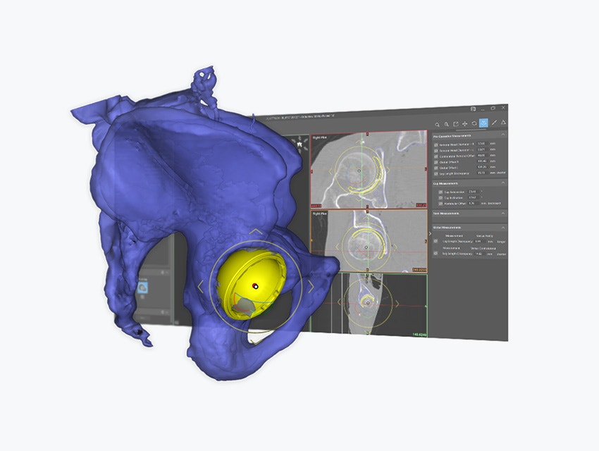 3D model of a human pelvis with a highlighted yellow hip implant component overlaid on a medical imaging software interface displaying CT scan cross-sections and measurement tools for surgical planning.