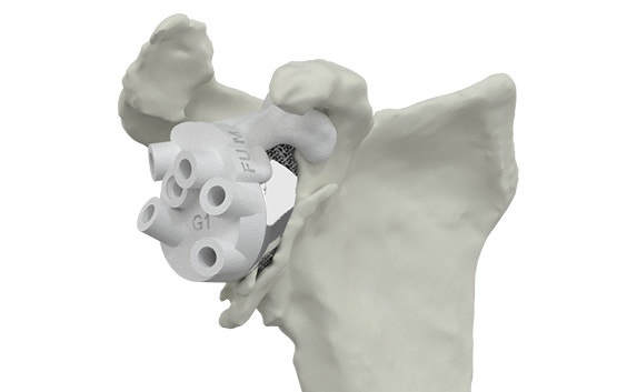 Imagen digital de una guía quirúrgica impresa en 3D en un hueso del hombro
