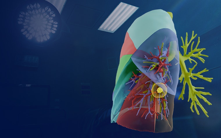 Digital image of segmented lungs from Mimics Planner for thoracic surgery with surgical lights in the background