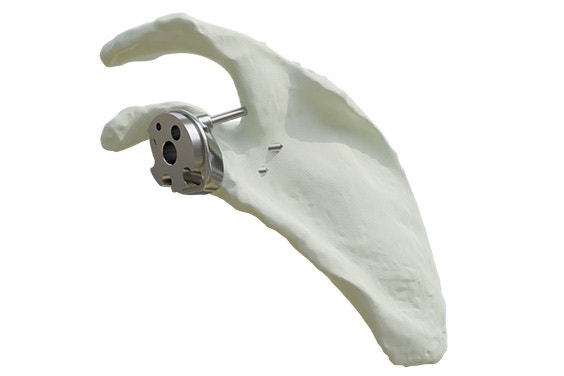 Virtual model showing the side view of a personalized Glenius implant in a shoulder