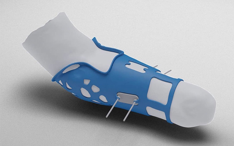 3D-printed sleeve for prosthetics on a model arm