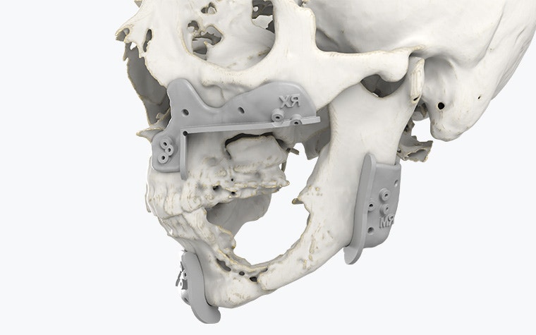 Vista lateral de un cráneo con guías quirúrgicas impresas en 3D colocadas alrededor de la mandíbula.