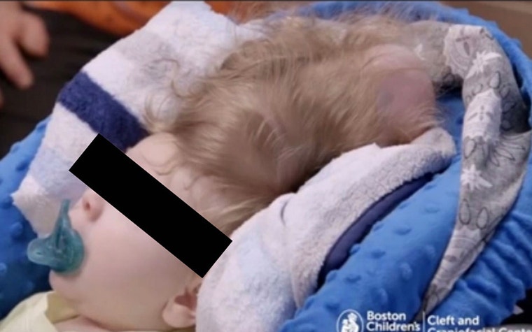 Image of the baby with its brain outside of its skull before surgery