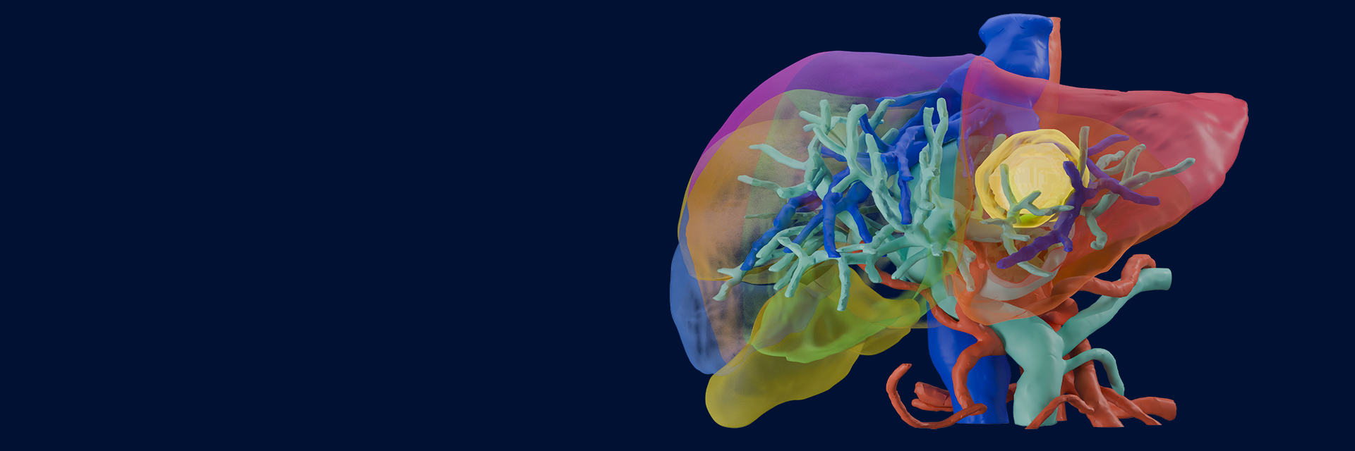 3D medical visualization of the liver with semi-transparent anatomy, showing detailed blood vessels and a highlighted yellow tumor-like mass in the upper section.