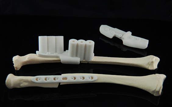 3D-printed bones with personalized surgical guides attached 
