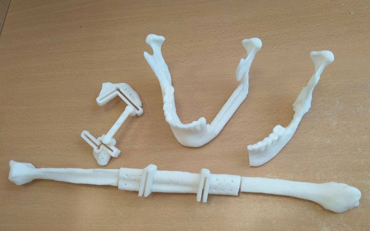 3D models of the diseased mandible, fibula, and reconstructed mandible next to 3D-printed surgical guides 