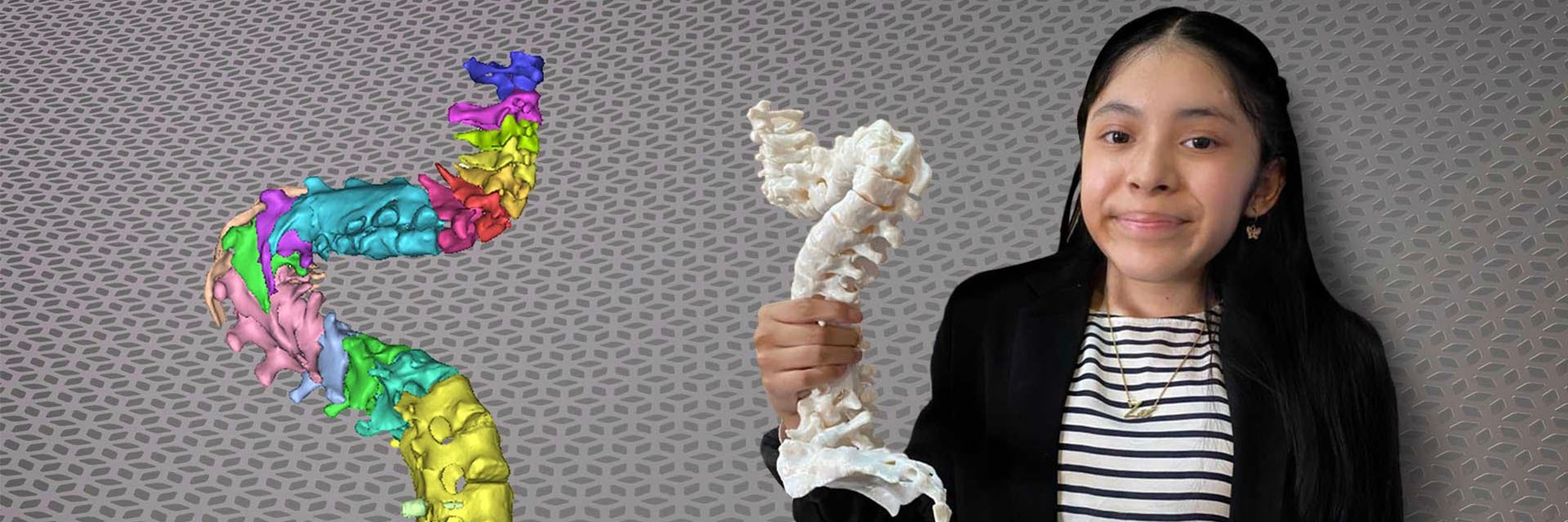 Patient holding a 3D-printed model of her spine next to a digital image of her spine