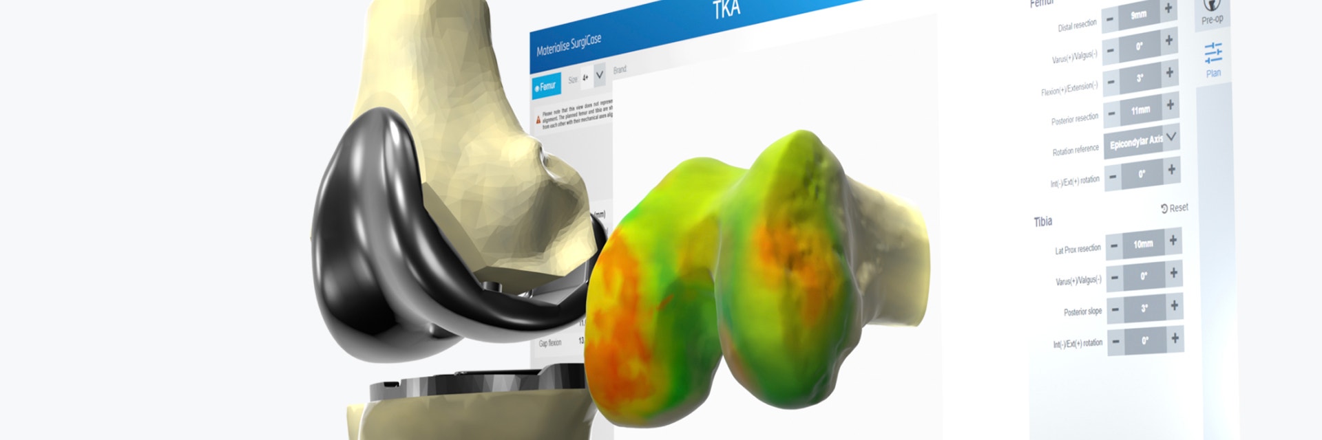 Visualization of a knee coming out of a computer screen next to a digital knee model with an implant