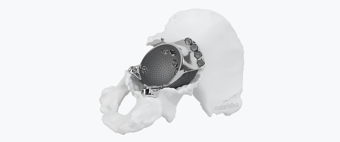 3D-gedrucktes aMace Hüftimplantat auf einem Hüftmodell