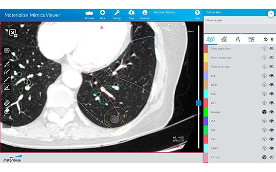 Screenshot of the Mimics Planner, showing non-contrasted CT images