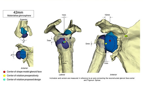 Gráfico que muestra las medidas de la glenoides