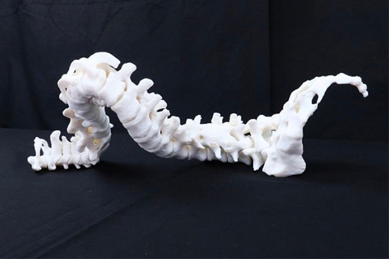 3D-printed model of the patient's spine